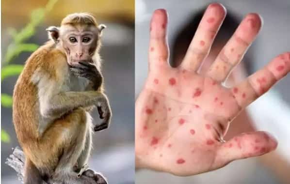 monkeypox-virus-disease-outbreak Monkeypox Virus Disease Outbreak