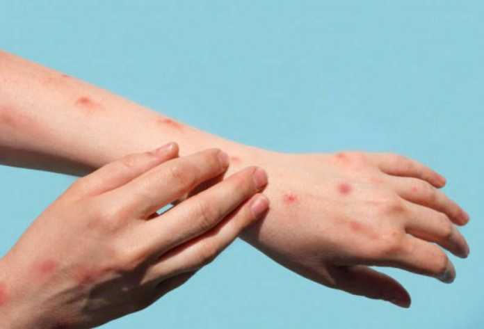 monkeypox-virus-reaches-another-50-new-countries Monkeypox virus reaches another 50 new countries