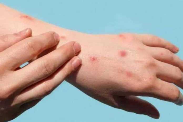 The U.S. reported 14000 monkeypox cases